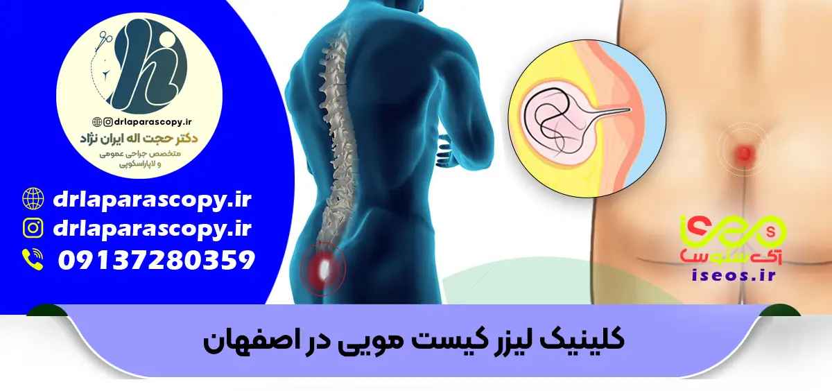 بهترین جراح کیست مویی در اصفهان