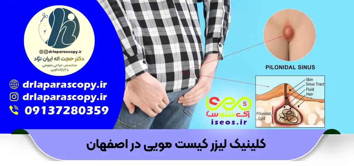 بهترین جراح کیست مویی در اصفهان