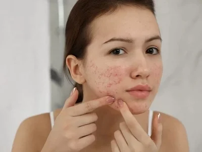  کرم ضد لک برای جای جوش؛ رفع اسکار و لک