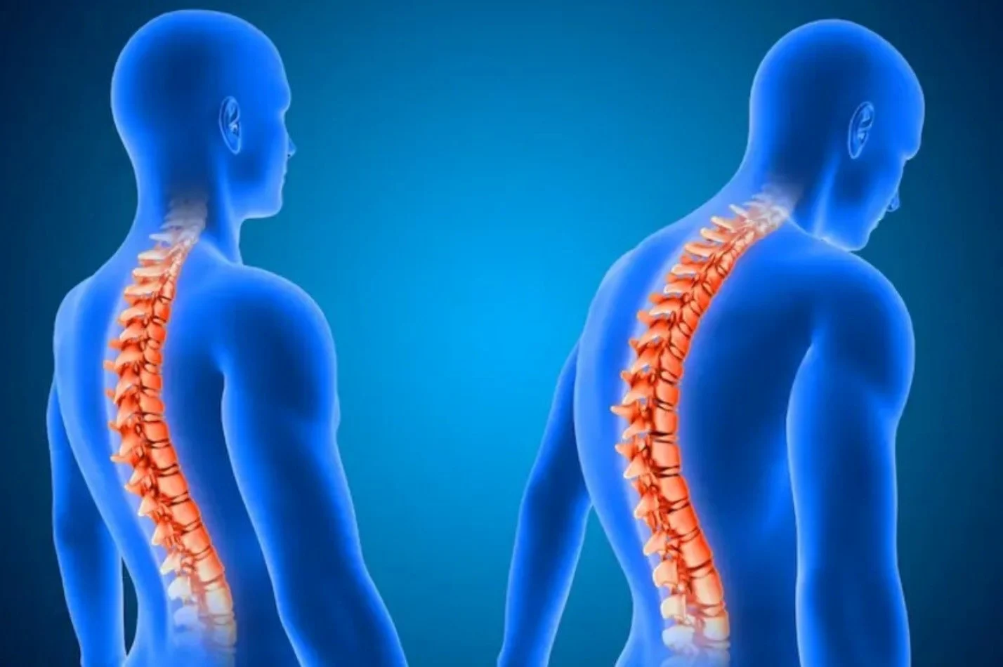 کیفوز چیست؟ چگونه با تمرینات ساده در خانه آسیب‌دیدگی را کنترل کنیم؟