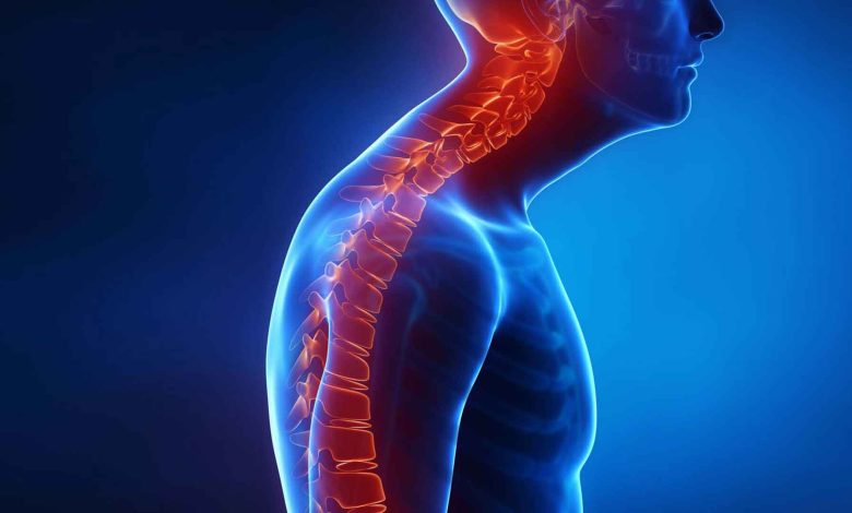 نقش تغذیه و سبک زندگی در کنترل کیفوز