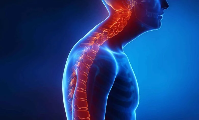 نقش تغذیه و سبک زندگی در کنترل کیفوز
