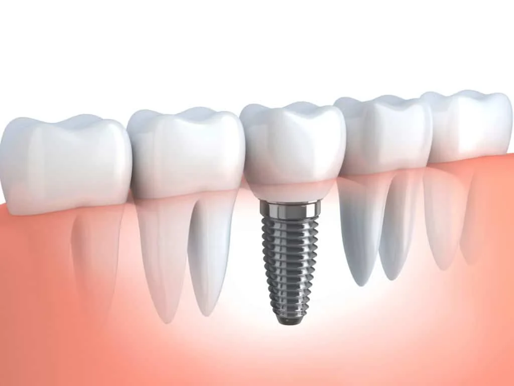 ایمپلنت اگر پیچ ایمپلنت بیفتد چه کنیم؟ + علت درآمدن پایه ایمپلنت