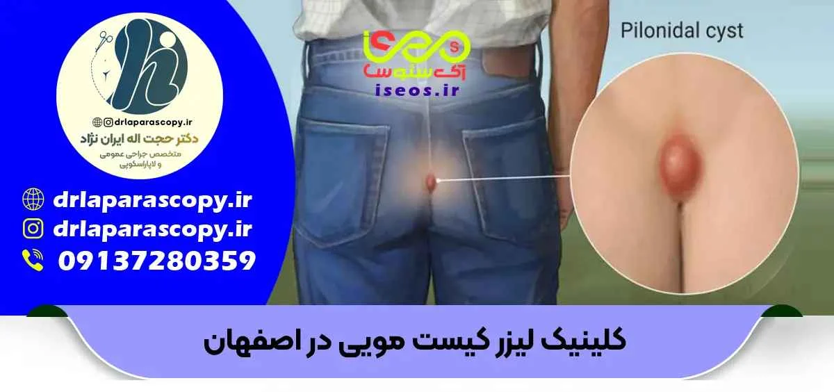 بهترین جراح کیست مویی در اصفهان
