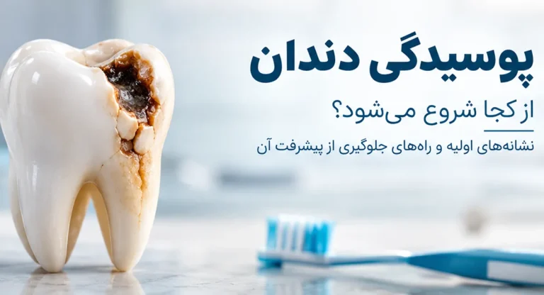 پوسیدگی دندان از کجا شروع می‌شود؟ نشانه‌های اولیه و راه‌های جلوگیری از پیشرفت آن